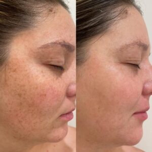 Results after 2 x Lumecca Treatments